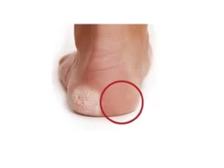 EasyPedipeel Hornhautschleifgerät mit ergonomischem Handgriff